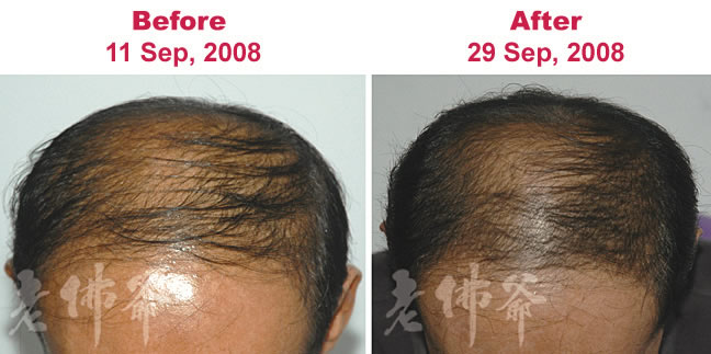 SG Oily Treatment For Hair Loss – Natural Hair Care Tips